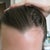 PRP for Hair Loss - 189 Reviews - 247 photos - 577 Q/A ...