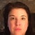 Asymmetrical eyes after botox