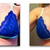 B to D Cup Breast Augmentation - Photos